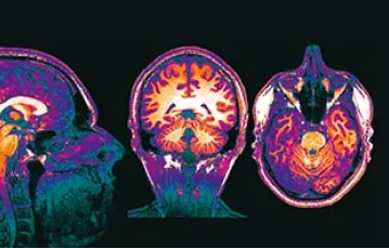 Mózg autora tekstu zobrazowany metodą rezonansu magnetycznego / Fot. Archiwum Prywatne
