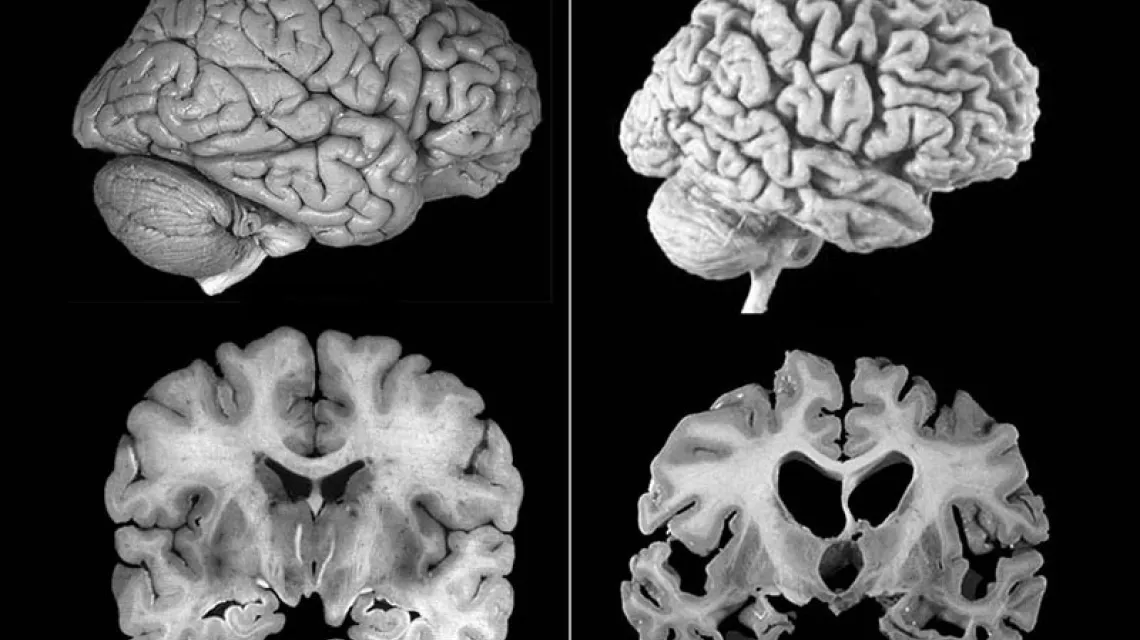 Po lewej: mózg zdrowego pacjenta, po prawej: mózg pacjenta z chorobą Alzheimera / Fot. Domena Publiczna