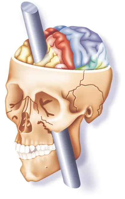 Schematyczna wizualizacja czaszki Phineasa Gage'a  / il. GETTY IMAGES
