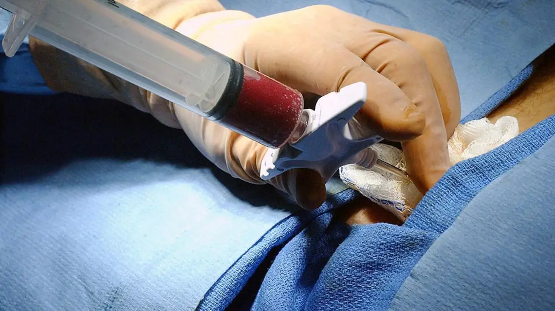 Biopsja aspiracyjna szpiku kostnego / Fot. Wikipedia