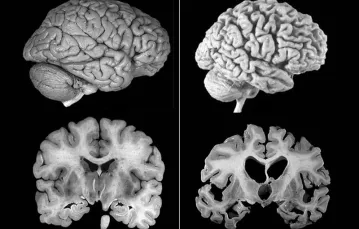 Po lewej: mózg zdrowego pacjenta, po prawej: mózg pacjenta z chorobą Alzheimera / Fot. Domena Publiczna